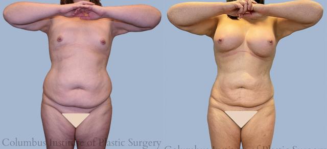 Liposuction result at Columbus Institute in Columbus, OH