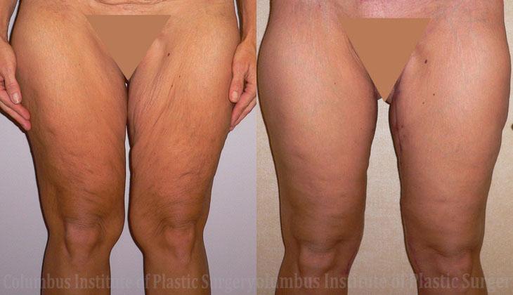 Columbus Institute thigh lift after — Columbus, OH