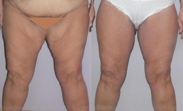 CoolSculpting before at Columbus Institute in Columbus, OH