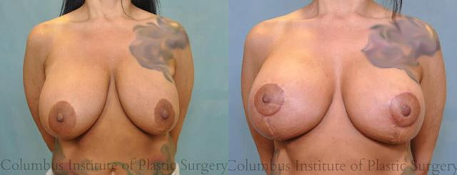 Breast Lift result at Columbus Institute in Columbus, OH