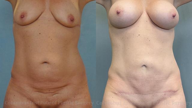 Breast Augmentation result at Columbus Institute in Columbus, OH