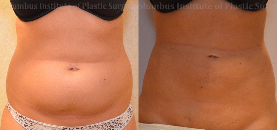 Columbus Institute breast reduction result — Columbus, OH