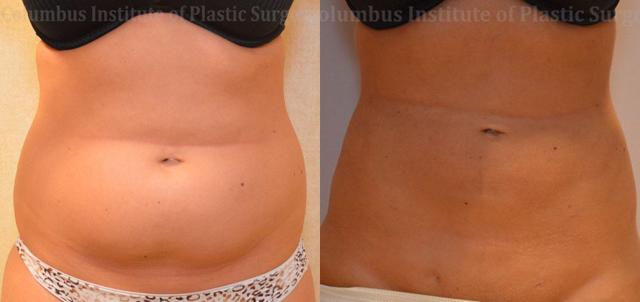 Breast Reduction result at Columbus Institute in Columbus, OH