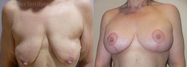 Breast Augmentation result at Columbus Institute in Columbus, OH