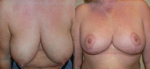 Breast Reduction result at Columbus Institute in Columbus, OH