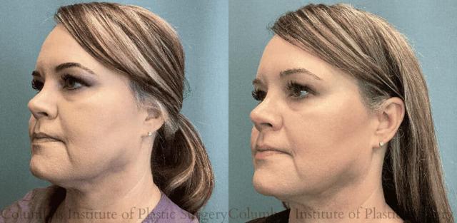Breast Reduction result at Columbus Institute in Columbus, OH