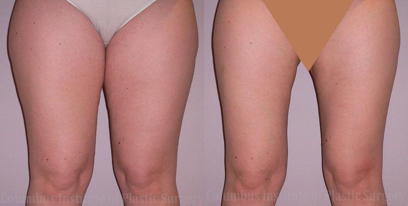 Columbus Institute breast reduction result — Columbus, OH