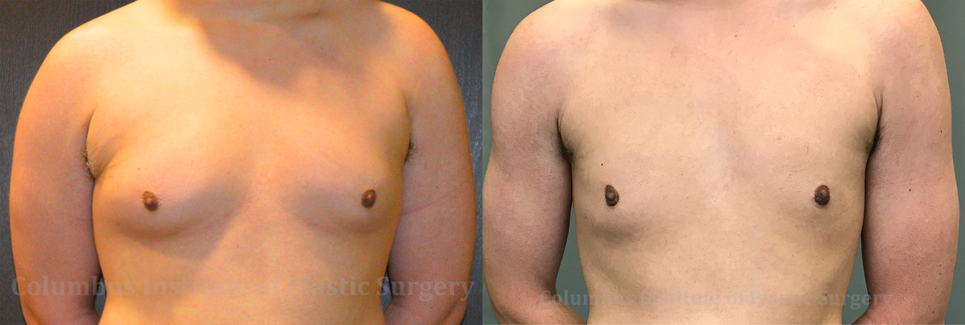 Columbus Institute gynecomastia result — Columbus, OH