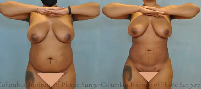 Liposuction result at Columbus Institute in Columbus, OH