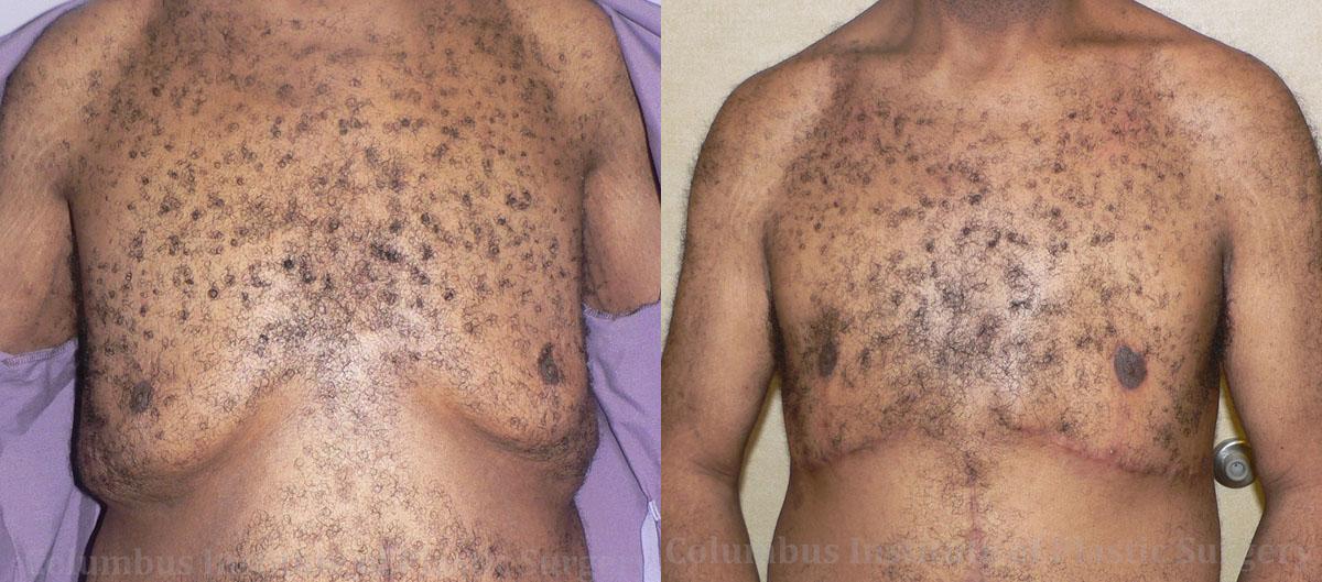 Columbus Institute gynecomastia result — Columbus, OH