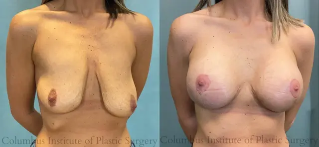 Breast Lift result at Columbus Institute in Columbus, OH