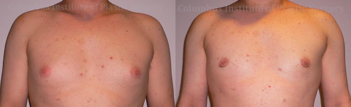 Columbus Institute gynecomastia result — Columbus, OH