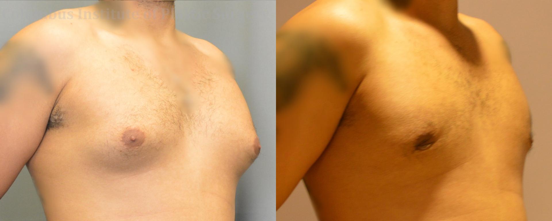 Columbus Institute gynecomastia result — Columbus, OH