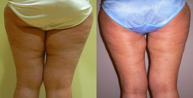 Thigh Lift after at Columbus Institute in Columbus, OH
