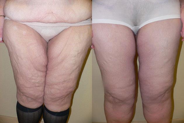 Thigh Lift before at Columbus Institute in Columbus, OH