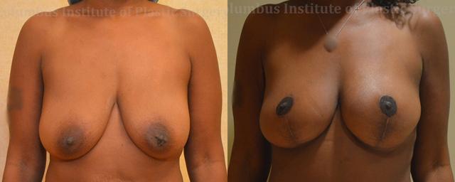 Breast Lift result at Columbus Institute in Columbus, OH