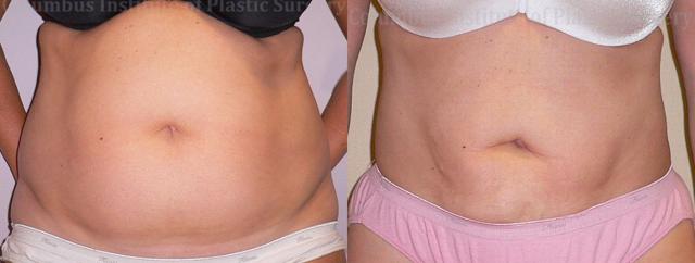 Breast Reduction result at Columbus Institute in Columbus, OH