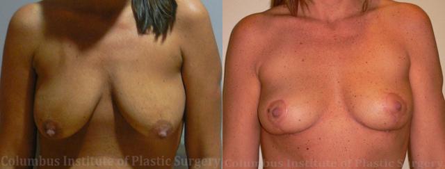 Breast Lift result at Columbus Institute in Columbus, OH