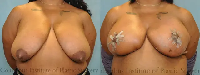 Breast Reduction result at Columbus Institute in Columbus, OH