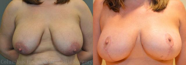 Breast Lift result at Columbus Institute in Columbus, OH