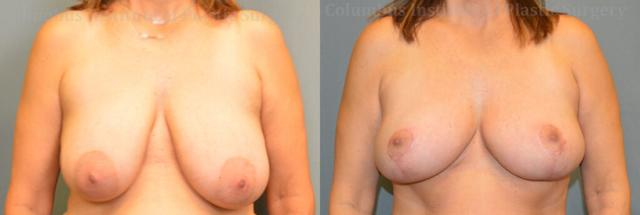 Breast Lift result at Columbus Institute in Columbus, OH