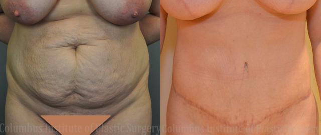 Breast Reduction result at Columbus Institute in Columbus, OH