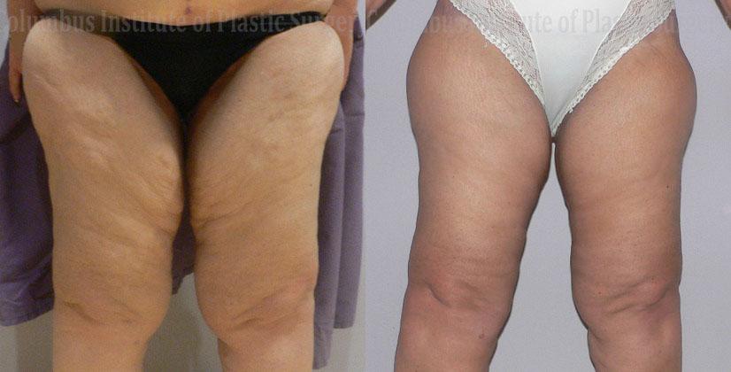 Columbus Institute thigh lift after — Columbus, OH