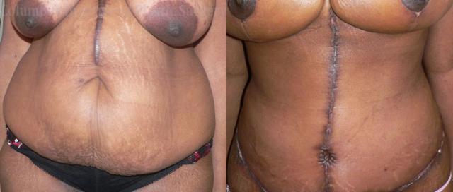 Tummy Tuck result at Columbus Institute in Columbus, OH