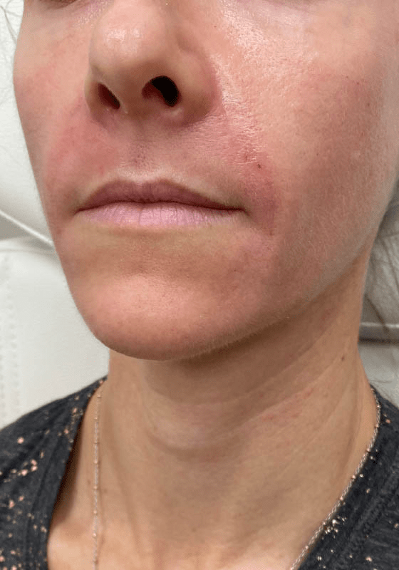 ZONA MED SPA after — Scottsdale, AZ