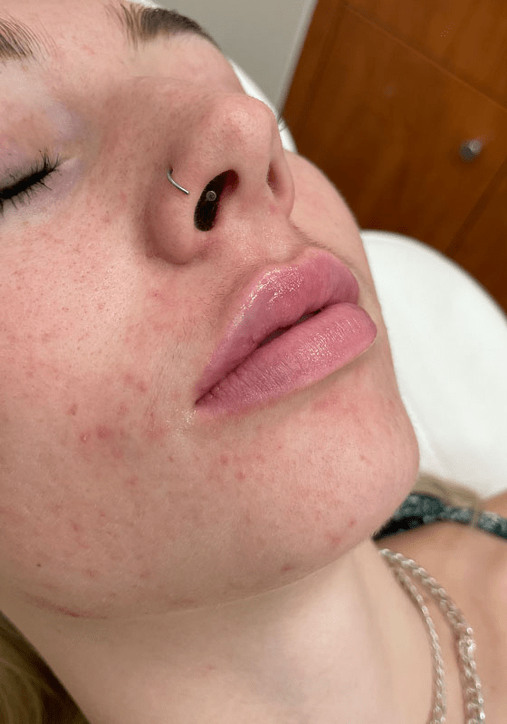 Dermal Fillers after at ZONA MED SPA in Scottsdale, AZ