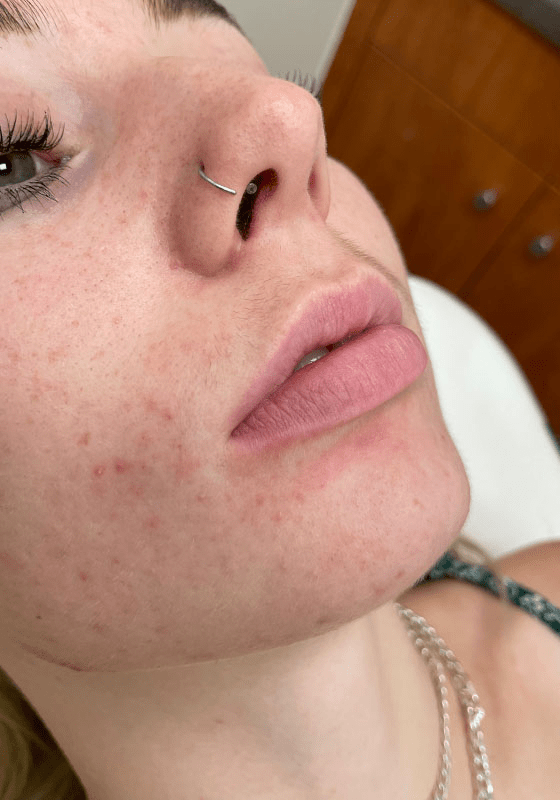 Dermal Fillers before at ZONA MED SPA in Scottsdale, AZ