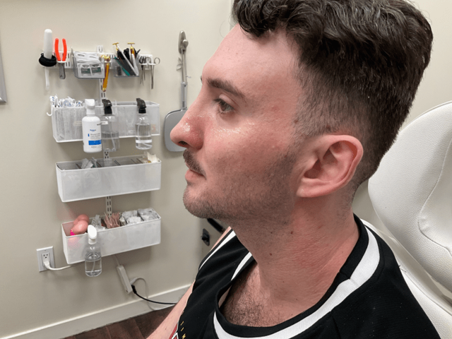 Functional Rhinoplasty before at ZONA MED SPA in Scottsdale, AZ