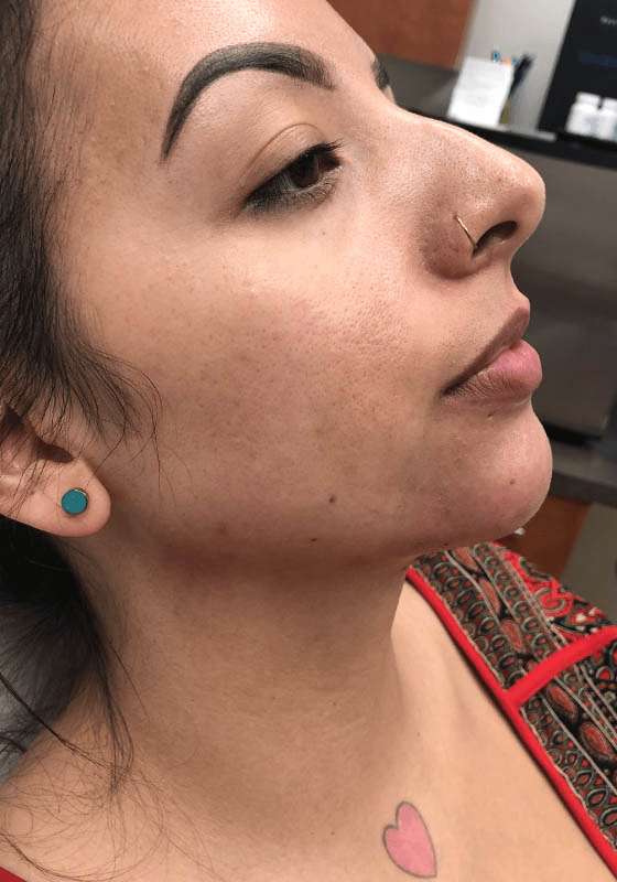 ZONA MED SPA after — Scottsdale, AZ