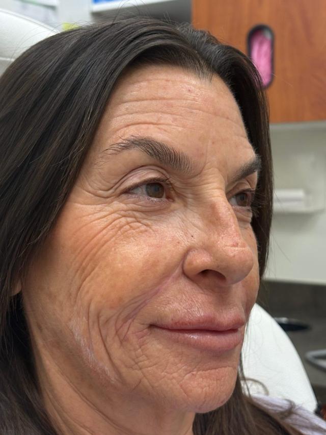 Juvederm after at ZONA MED SPA in Scottsdale, AZ