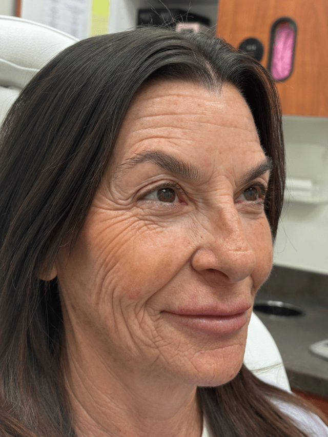 Juvederm before at ZONA MED SPA in Scottsdale, AZ