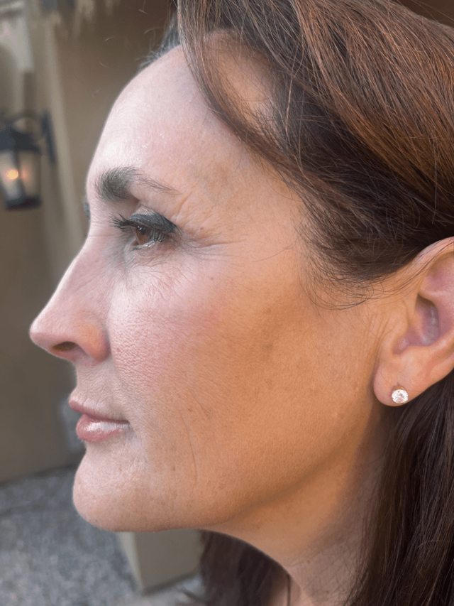 Botox after at ZONA MED SPA in Scottsdale, AZ