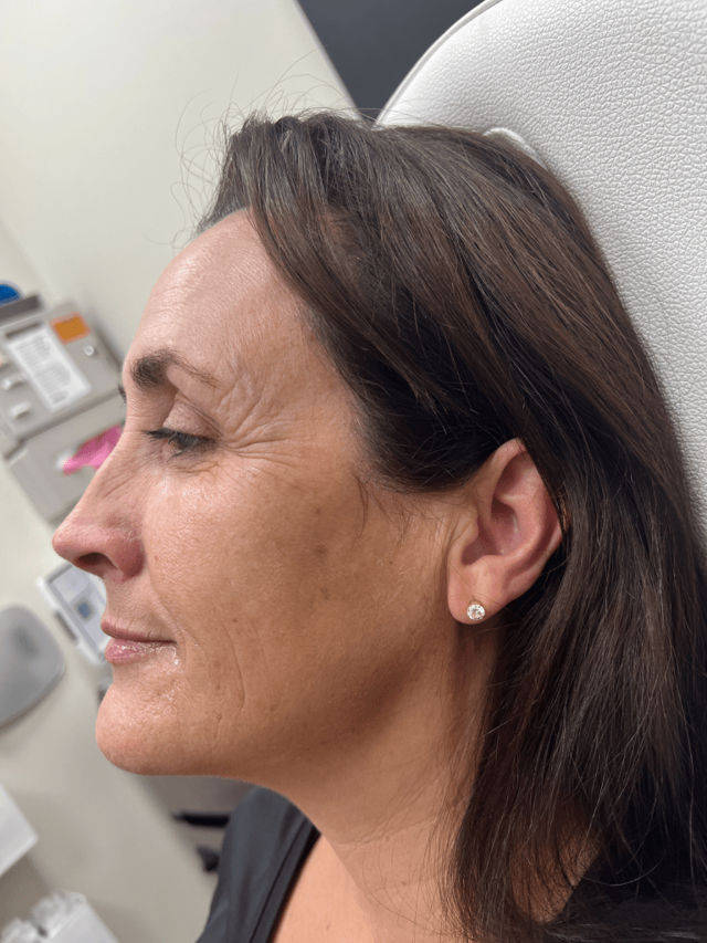 Botox before at ZONA MED SPA in Scottsdale, AZ