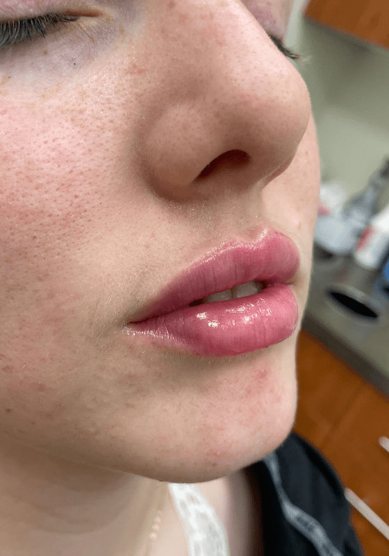 Dermal Fillers after at ZONA MED SPA in Scottsdale, AZ