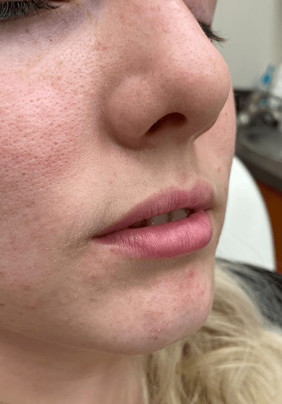 Dermal Fillers before at ZONA MED SPA in Scottsdale, AZ