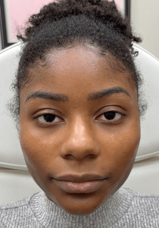 ZONA MED SPA after — Scottsdale, AZ