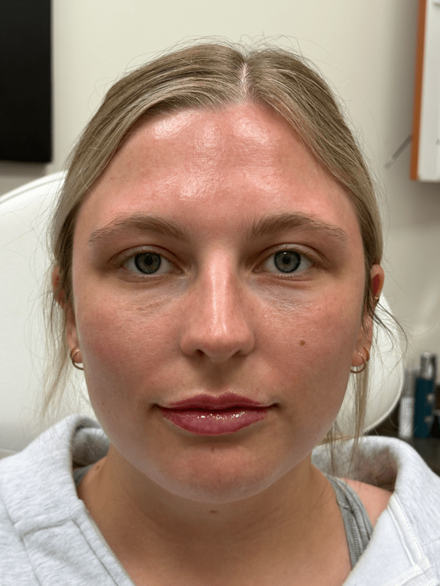 Dermal Fillers after at ZONA MED SPA in Scottsdale, AZ