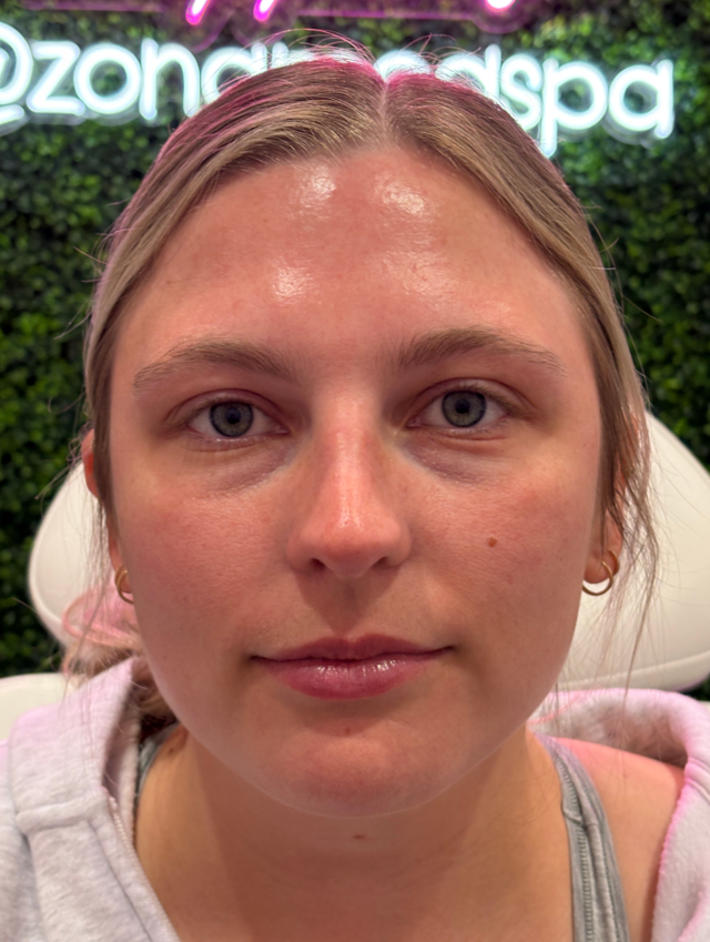 Dermal Fillers before at ZONA MED SPA in Scottsdale, AZ