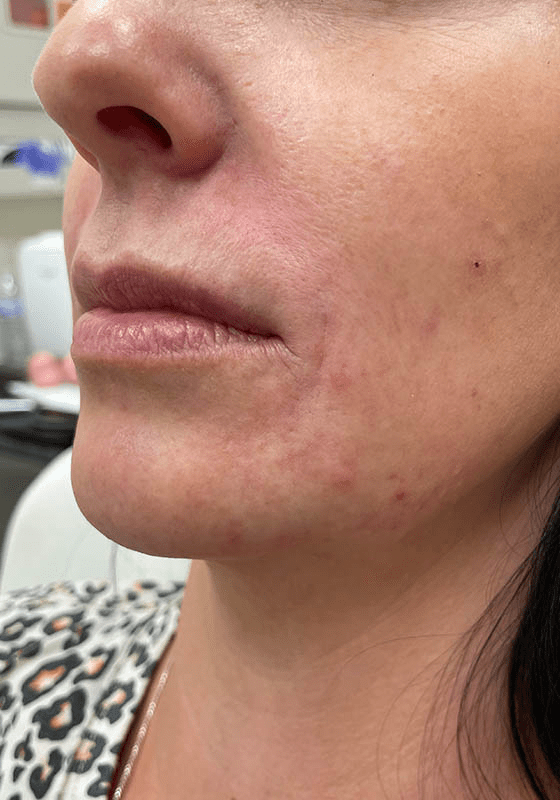 Dermal Fillers after at ZONA MED SPA in Scottsdale, AZ