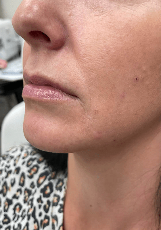 Dermal Fillers before at ZONA MED SPA in Scottsdale, AZ