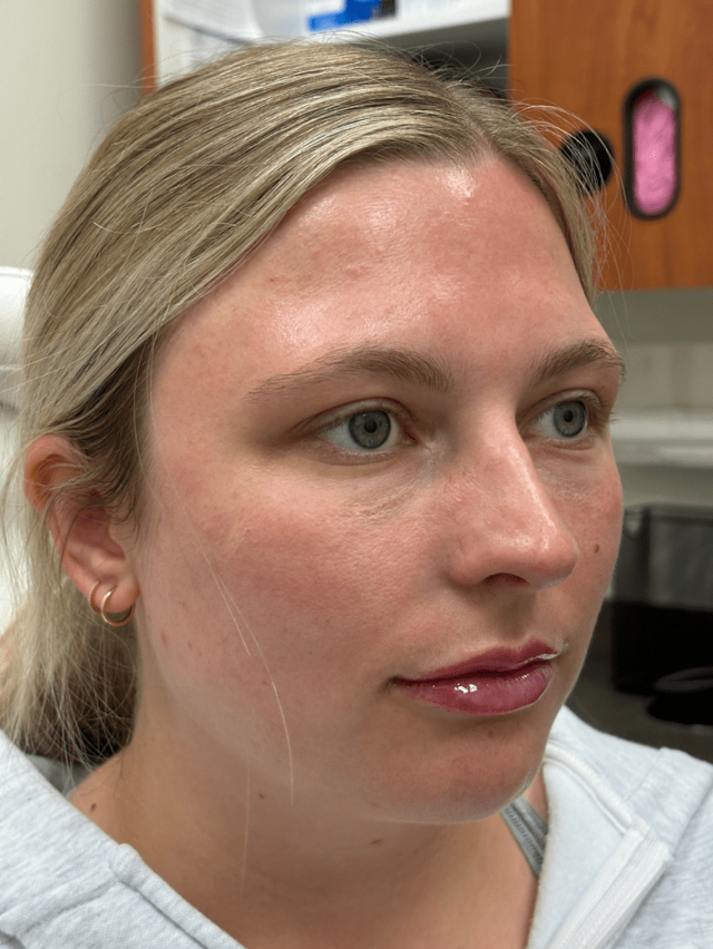 Juvederm after at ZONA MED SPA in Scottsdale, AZ
