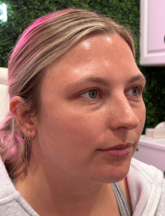 Juvederm before at ZONA MED SPA in Scottsdale, AZ
