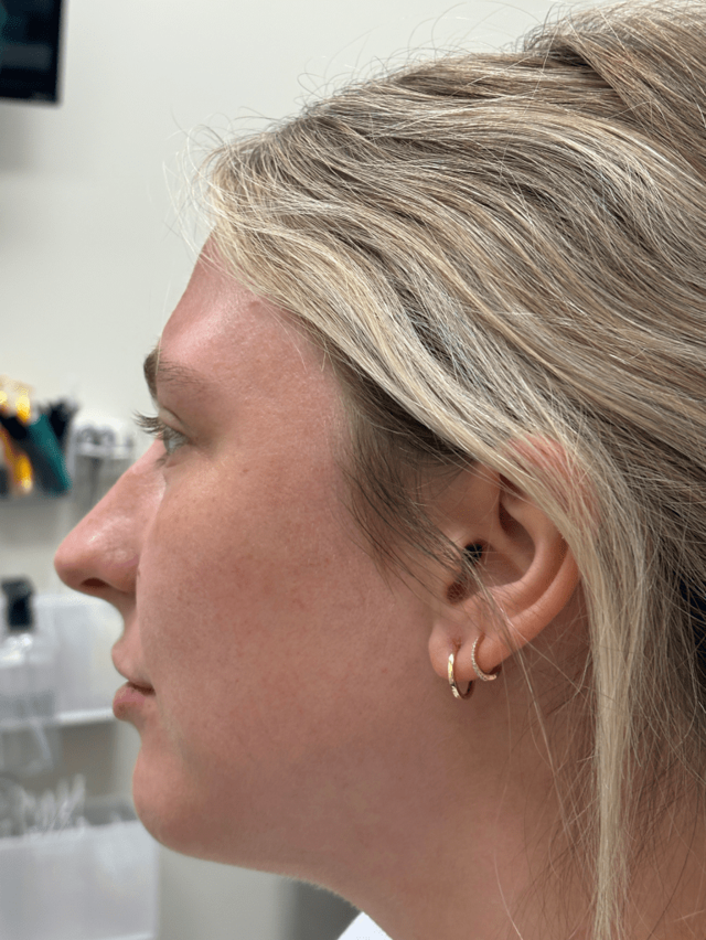 Functional Rhinoplasty after at ZONA MED SPA in Scottsdale, AZ