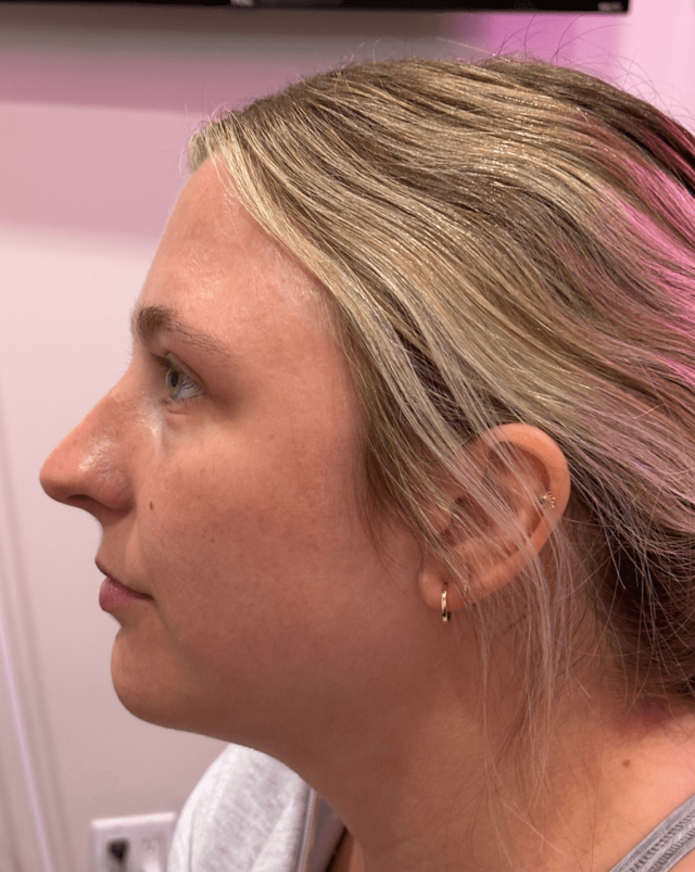 Functional Rhinoplasty before at ZONA MED SPA in Scottsdale, AZ