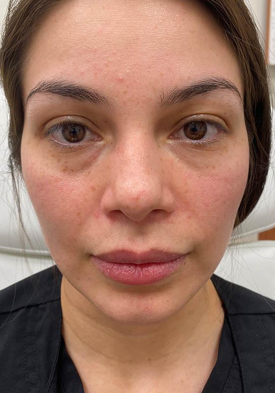 Juvederm before at ZONA MED SPA in Scottsdale, AZ
