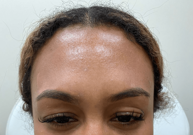 Botox after at ZONA MED SPA in Scottsdale, AZ